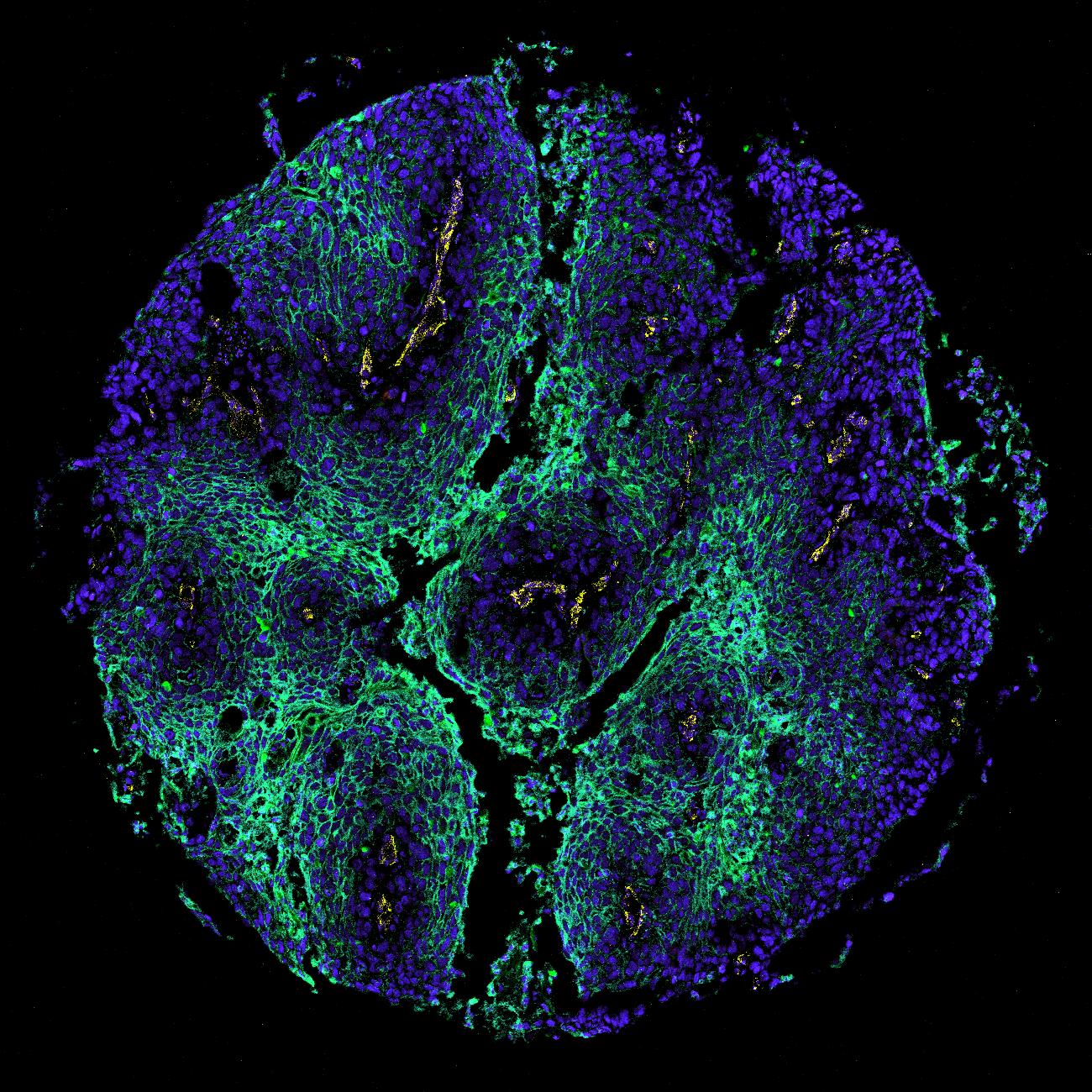 Lung TMA core