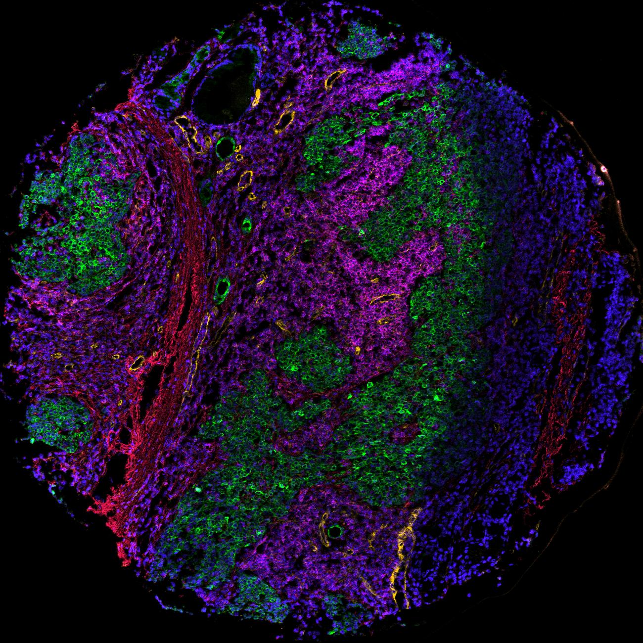 Lung Tumor Core — multiplexed imaging