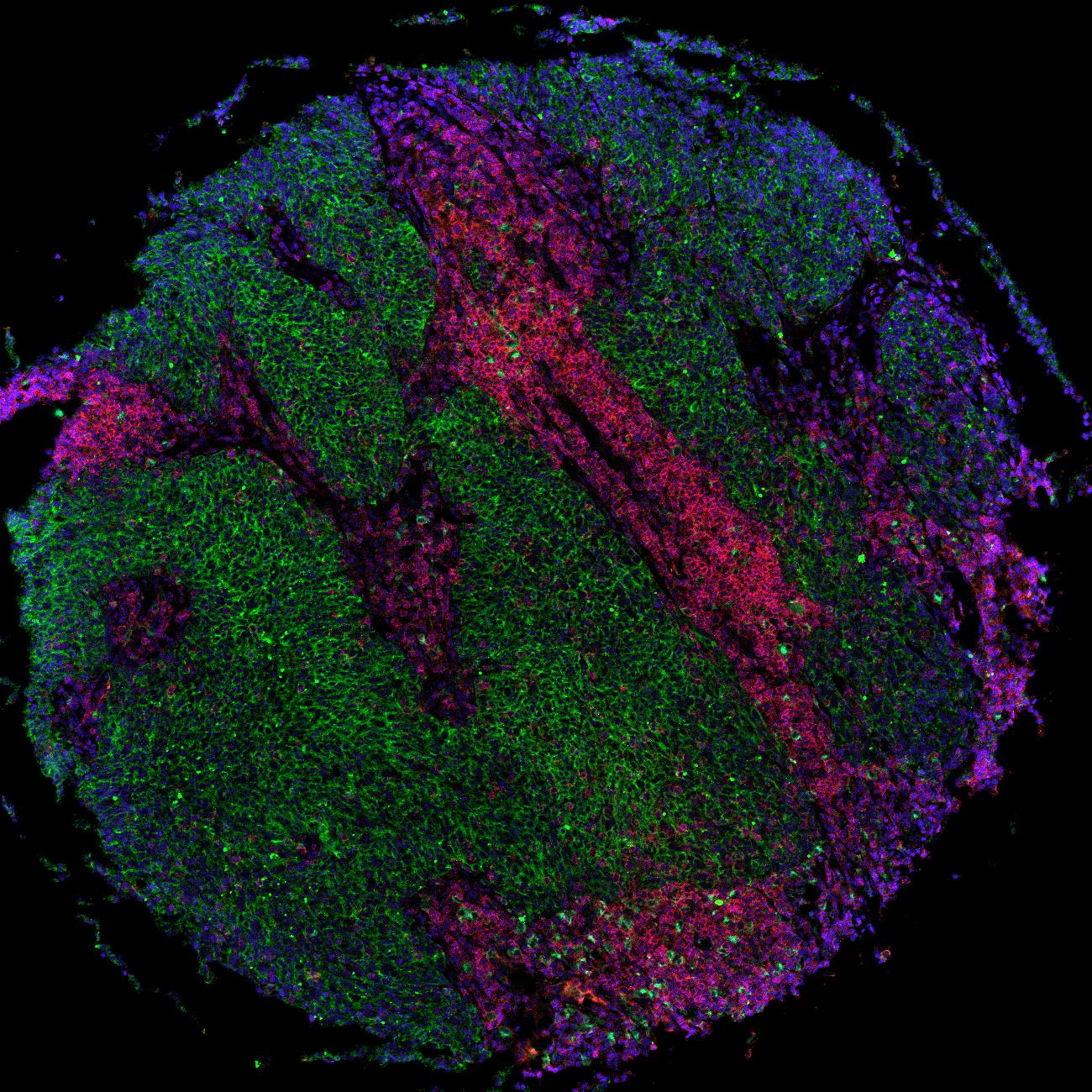 Lung TMA core